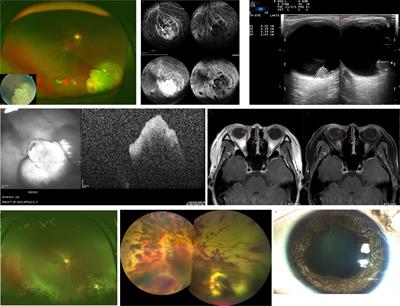 Retinoblastoma in Adults: Clinical Features, Gene Mutations and Treatment Outcomes: A Study of Six Cases